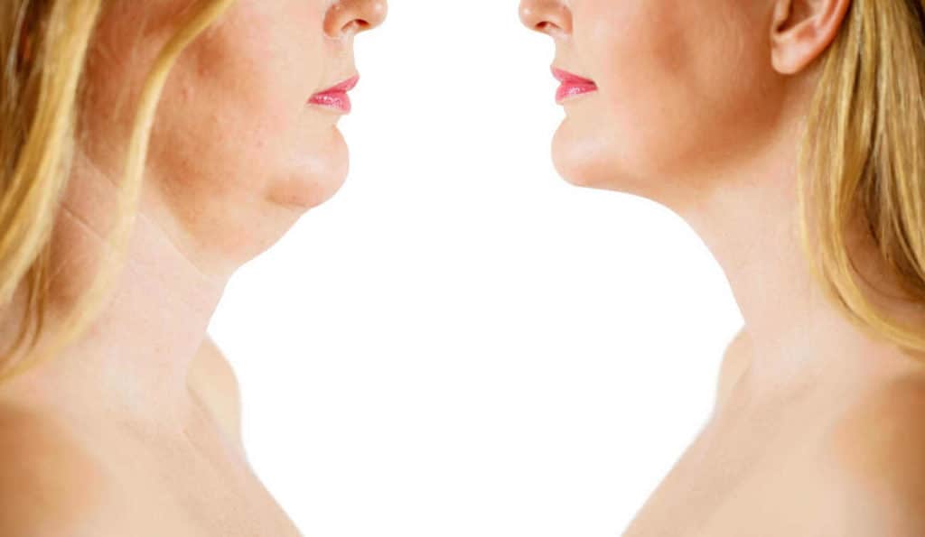 Double Chin treatment North Wembley before and after results