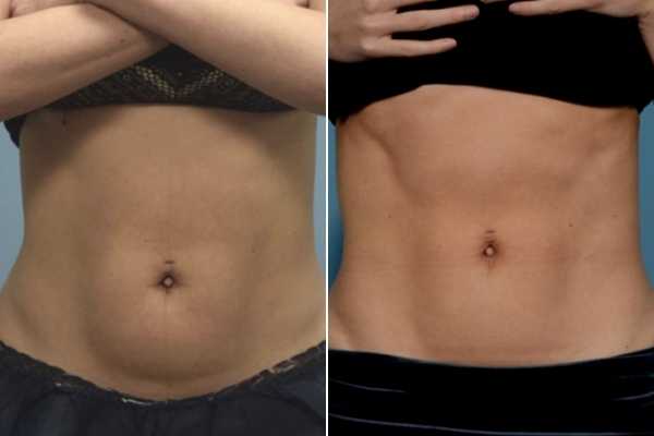 body sculpting FAQs North Wembley