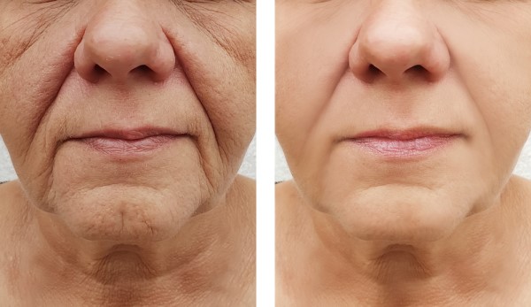 Learn more about Morpheus8 Treatment North Wembley today!