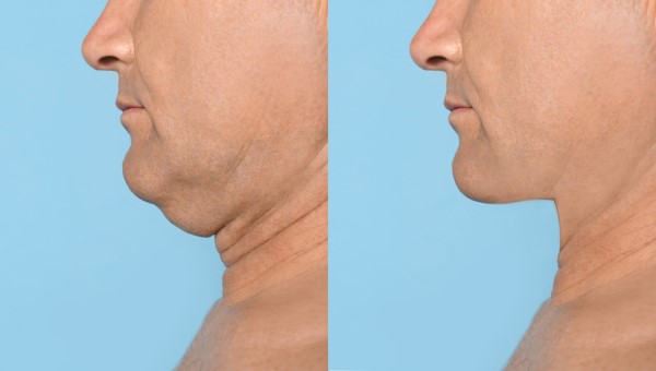 Which Non-Surgical Treatments Work Best for Jowls and Loose Skin North Wembley?