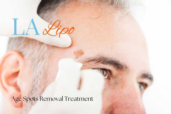 What Are the Most Effective Treatments for Age Spots North Wembley?
