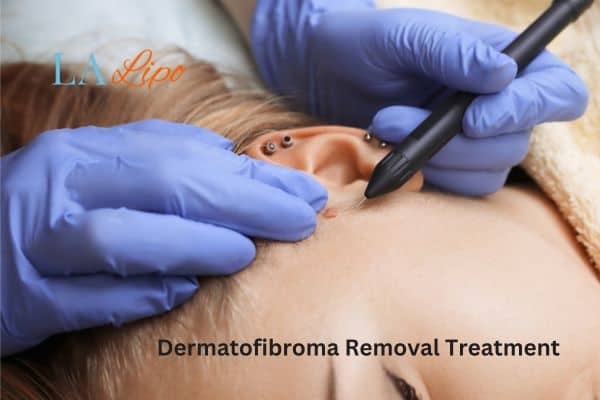 Dermatofibroma Removal Treatment North Wembley