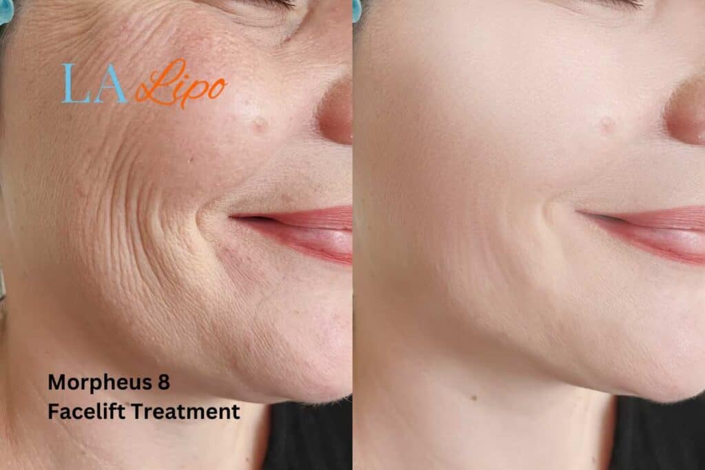 Morpheus8 Treatment North Wembley for flawless skin! Call us today!