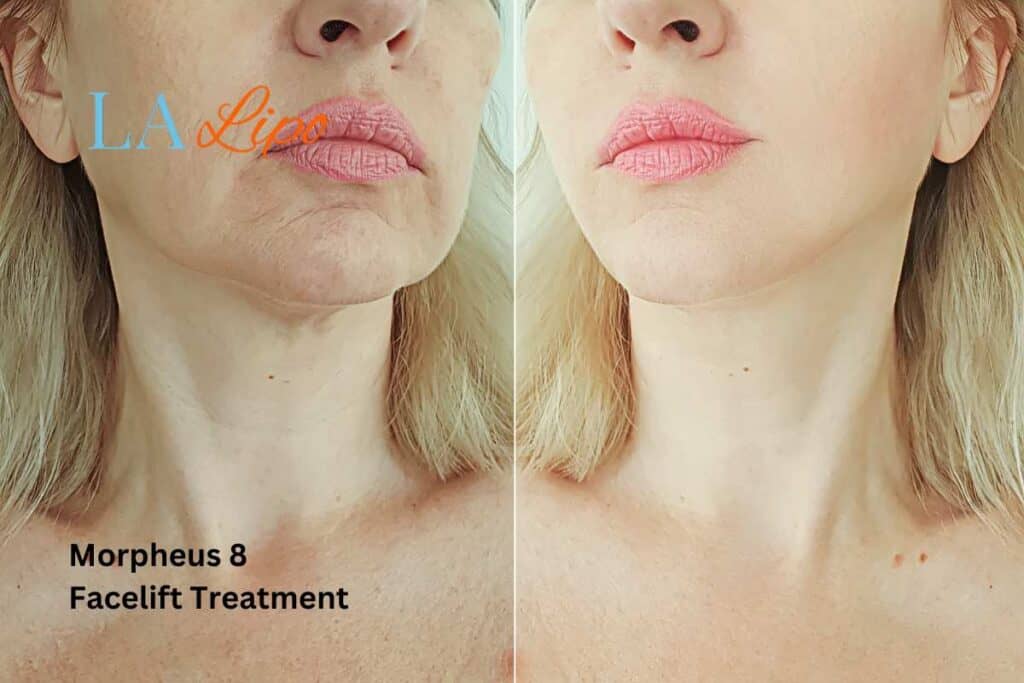Turn back time with Morpheus8 Treatment North Wembley