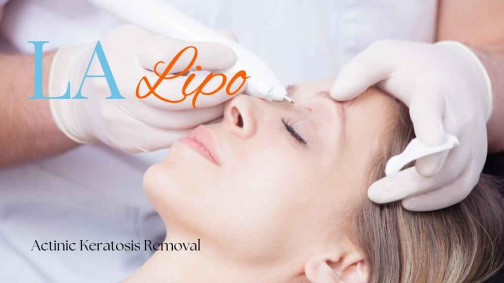 actinic keratosis removal North Wembley