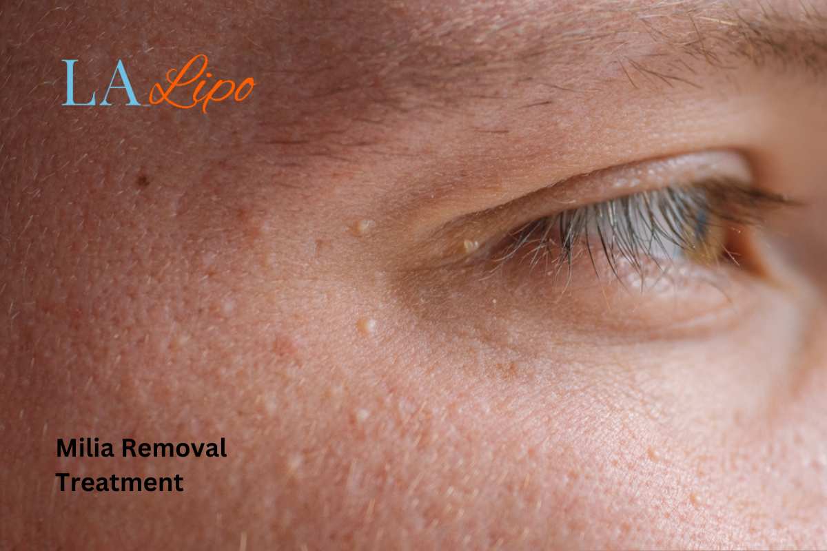 Cryopen Milia Removal: Is It the Easiest and Safest Option North Wembley?