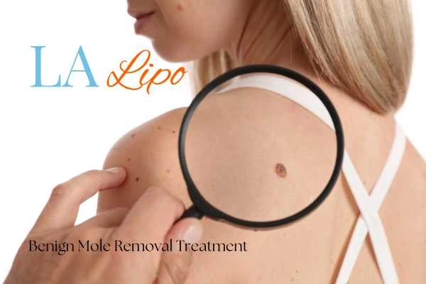 Why getting moles removed North Wembley can boost your confidence!