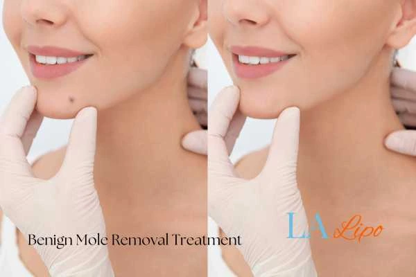 Woman's before and after results of being moles removal treatment North Wembley
