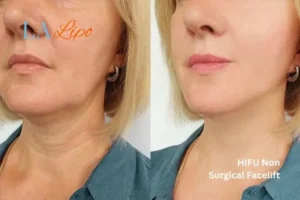 hi-fu for wrinkles North Wembley before and after results