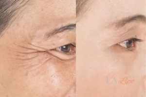 Before and after results of woman - HI-fu wrinkles reduction treatment North Wembley