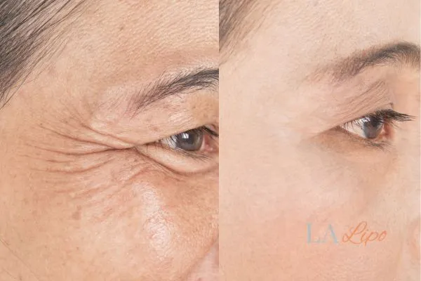 Before and after results of woman - HI-fu wrinkles reduction treatment North Wembley