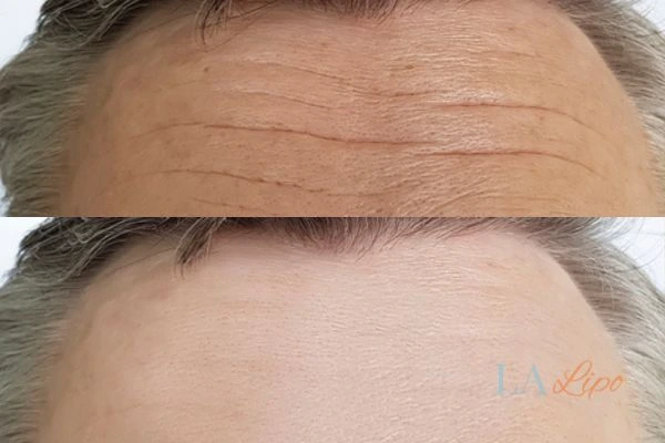 results of HIFU North Wembley on mans forehead to help reduce lines and wrinkles