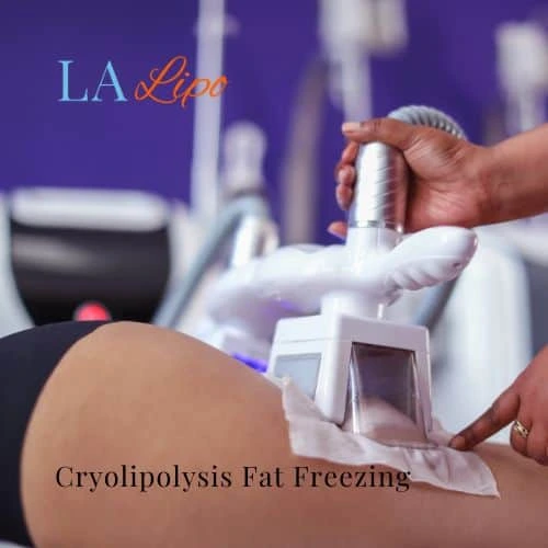 fat freezing - Cryolipolysis North Wembley