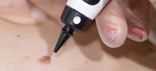 skin tag removal using cryopen North Wembley
