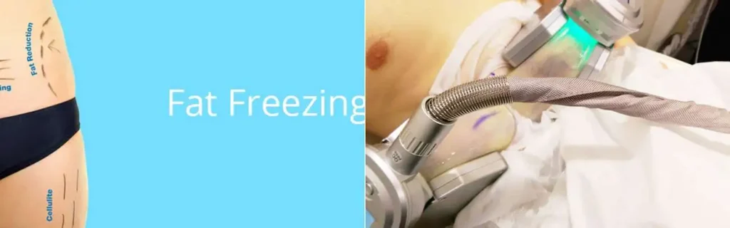 Fat freezing North Wembley on multiple areas of the body