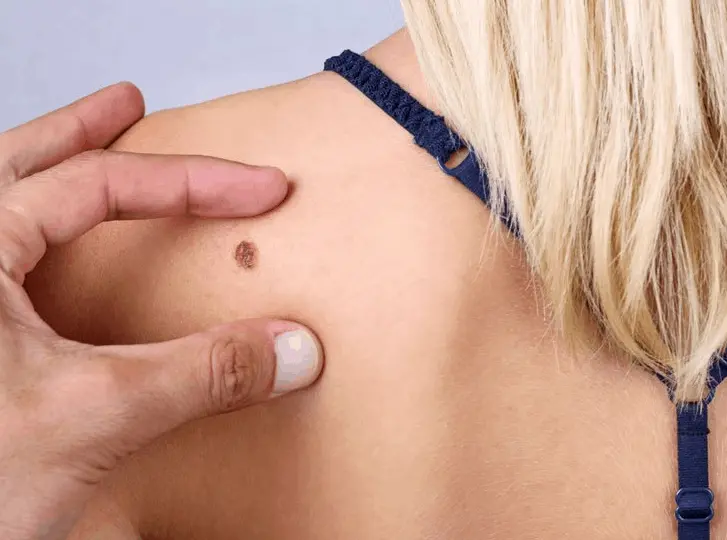 woman having mole removal North Wembley consultation before treatment.