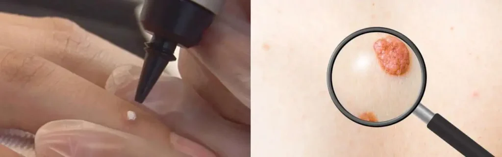 Cryopen for mole removal North Wembley - speak to our team today!