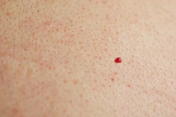close up of a cherry angioma North Wembley
