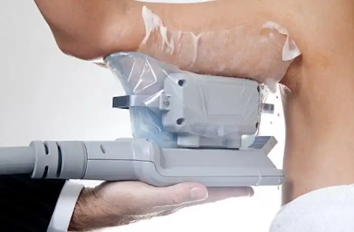Picture of fat freezing North Wembley on the upper arms.