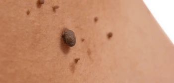 image of a skin tag North Wembley