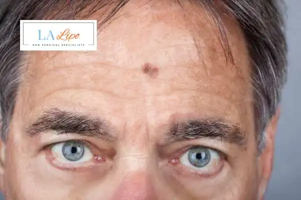 Solar Lentigo Removal North Wembley image of man with mark on his forehead