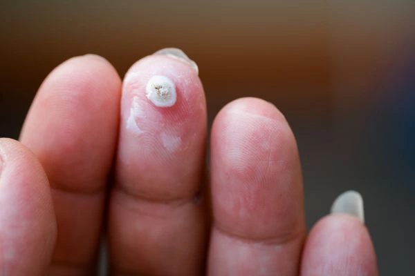 wart on person finger - cryotherapy to treat from LA LIPO North Wembley