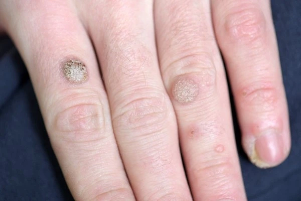 photo of warts on person hand - see wart removal North Wembley from LA LIPO