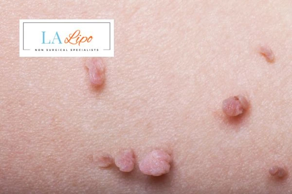 Does cryopen skin tag removal North Wembley hurt? Find out now call our team today!
