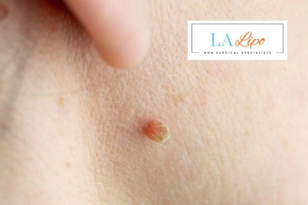 Book skin tag removal North Wembley today speak to our team now!