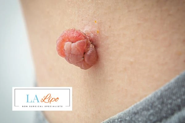 Interested in skin tag removal North Wembley? Concerned about the pain? Find out more today!