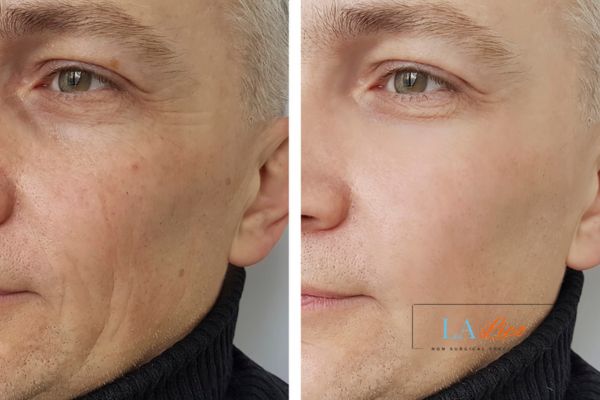 See the amazing results of Morpheus8 Treatment North Wembley!