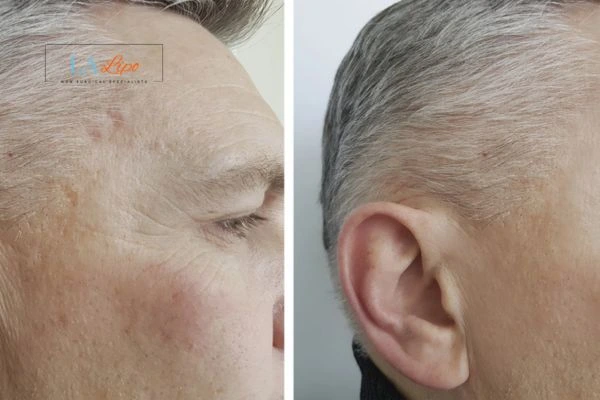Mens Before & After Morpheus 8 Results North Wembley