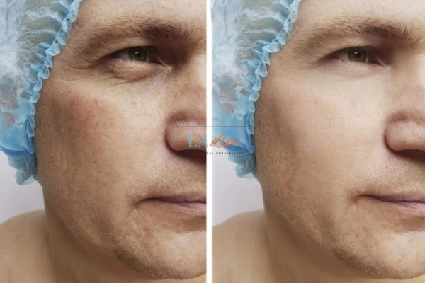 Before and after Morpheus 8 Results North Wembley