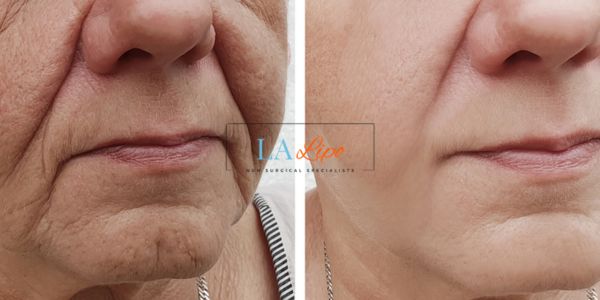 Older lady deeper wrinkle reduction - LA LIPO Morpheus 8 Results North Wembley