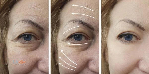 Amazing eye lift Morpheus 8 results North Wembley