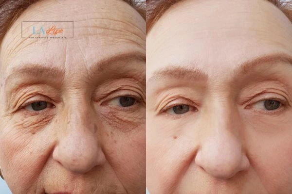The powerful benefits of Morpheus8 Treatment North Wembley - Call Our team today!