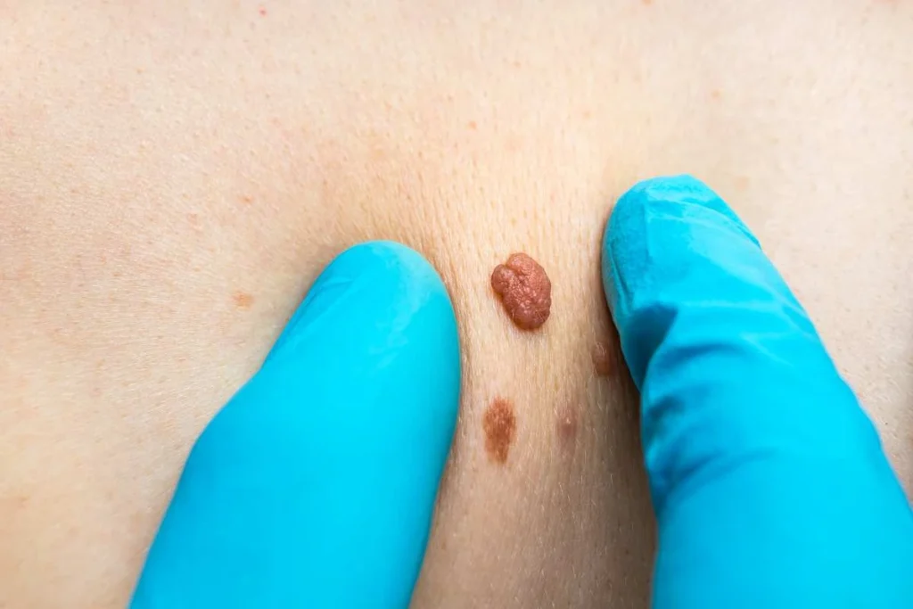 LA LIPO Cryopen Lesion Removal Prices North Wembley