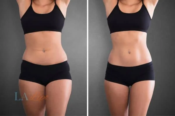 before and after results of non-surgical treatment to help a woman's body image and mental health North Wembley