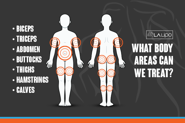 Diagram to show areas you can have LA-EMS Body Sculpting Treatment North Wembley