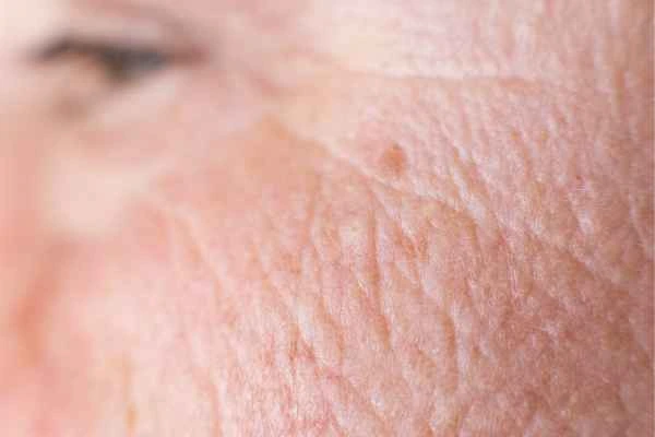 close up picture of a woman's face showing an age spot North Wembley