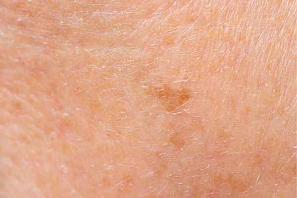 close up picture of age spots North Wembley