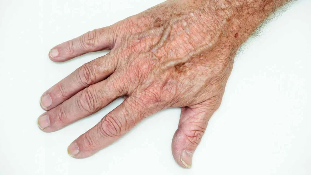 Male hand showing age spot North Wembley