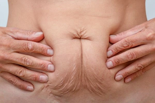 Image of a woman's stomach with loose skin - example of skin tightening North Wembley options