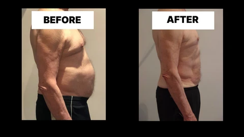What Symptoms Can Diastasis Recti Cause in Men? Weak Core, Back Pain and Poor Posture North Wembley
